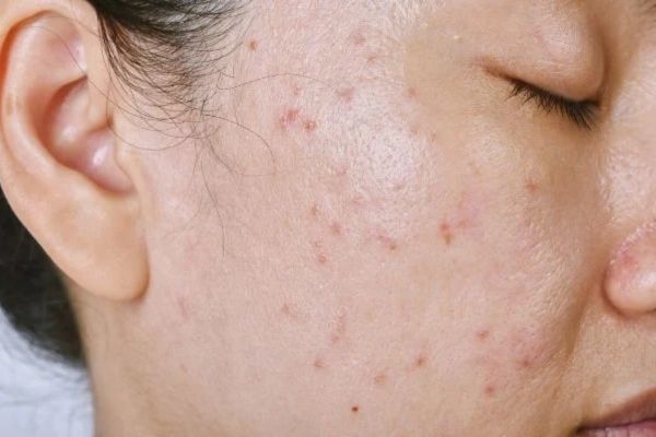 da dau mun can serum