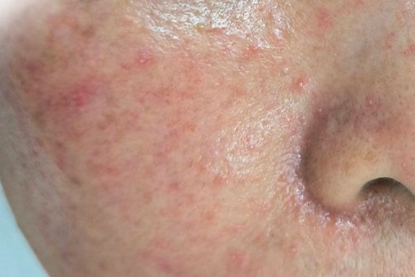 hang rao da bi ton thuong