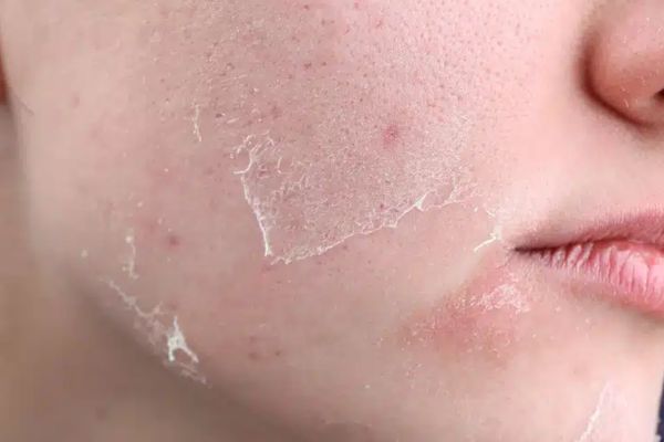 da sau peel can duoc phuc hoi bang serum