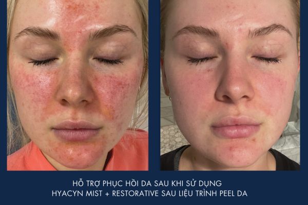 hydrinity cung cap serum phuc hoi da sau peel