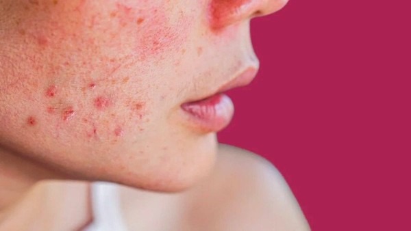 kem dưỡng ẩm cho da nhạy cảm